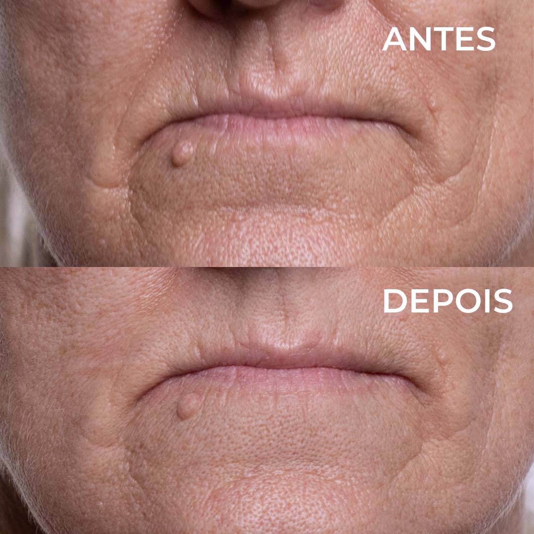 Plaquinhas Anti-Rugas Aquaderma® Testa, olhos e queixo