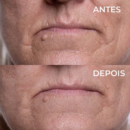 Plaquinhas Anti-Rugas Aquaderma® Testa, olhos e queixo