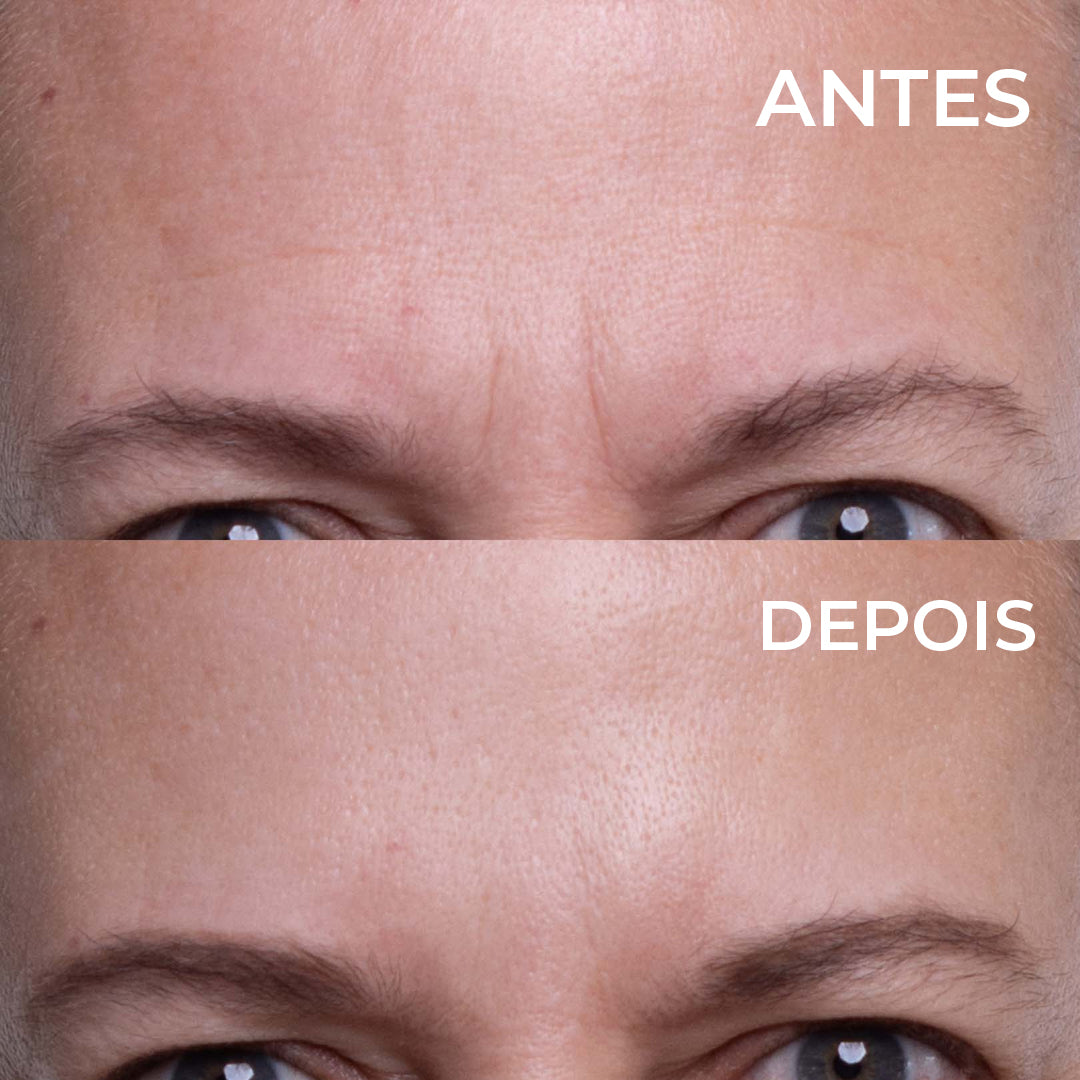 Plaquinhas Anti-Rugas Aquaderma® Testa, olhos e queixo